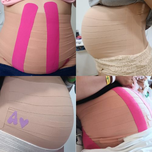 Taping Pós Parto